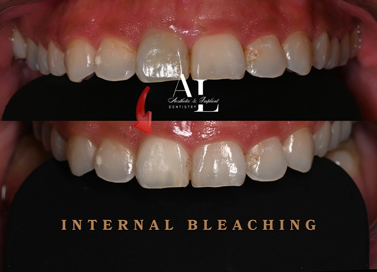 Before and after: Internal Bleaching for a Discolored Front Tooth