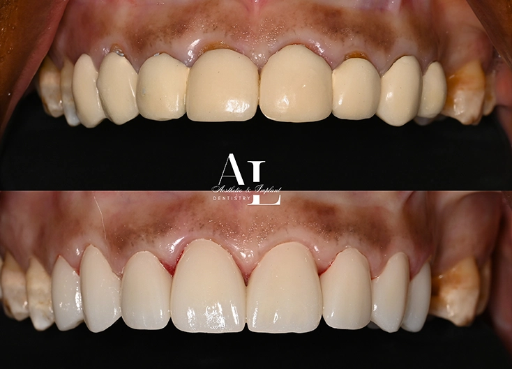 Before and after: Replacement of Existing Anterior Crowns