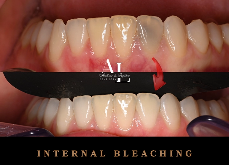 Before and after: Internal Bleaching After Root Canal Treatment