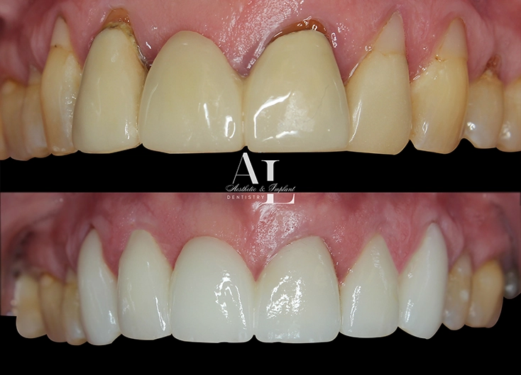 Before and after: Smile Rehabilitation with Crowns and Bridgework