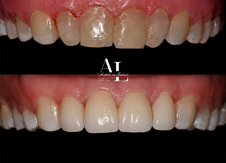 Before and after: Peg Lateral Correction with Dental Crowns