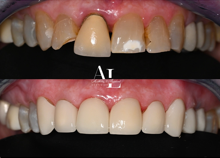 Before and after: Replacement of an Oversized Crown and Restoration of Fractured Teeth