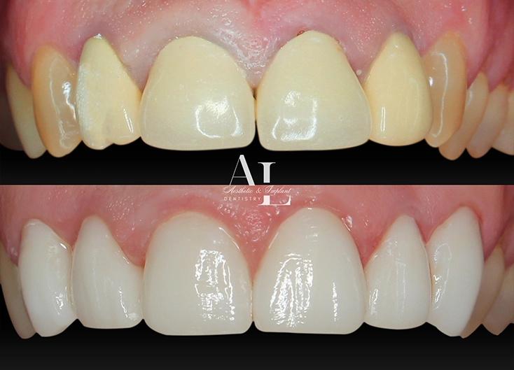 Before and after: Smile Makeover