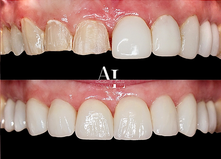 Before and after: Veneer Smile Makeover