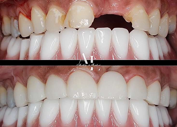 Before and after: Smile Makeover with Bridge and Crowns