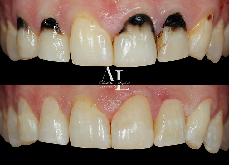 Before and after: Restoring Confidence with Conservative Fillings