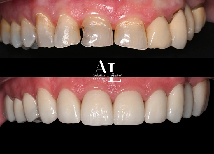 Before and after: Full-Arch Rehabilitation for Severe Tooth Wear