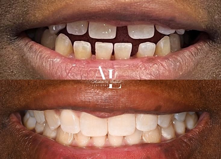 Before and after: Invisalign Treatment for Dental Spacing