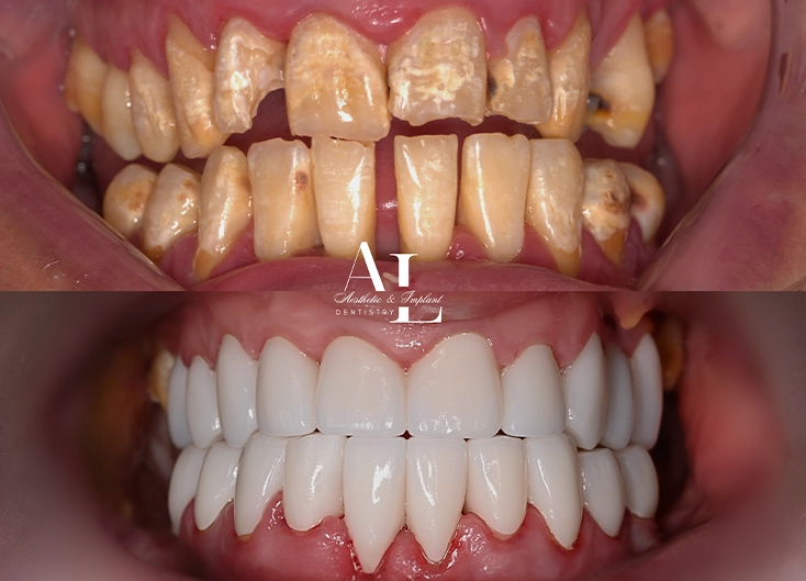 Before and after: Full-Mouth Rehabilitation