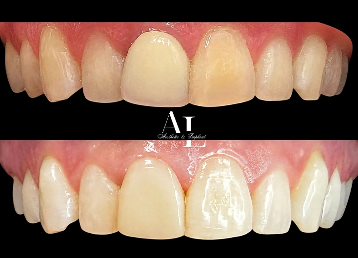 Before and after: Single Anterior Crown